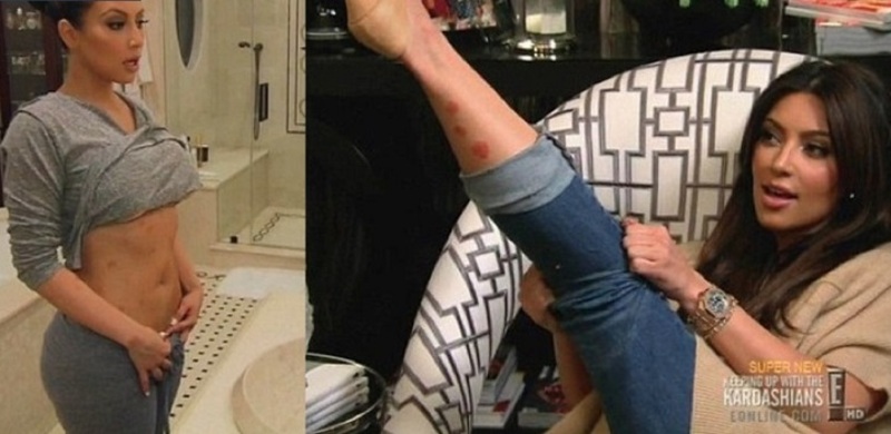 صور 8 مشاهير أصيبوا بأمراض جلدية خطيرة.. لن تصدقوا شكل قدم بريتني سبيرز